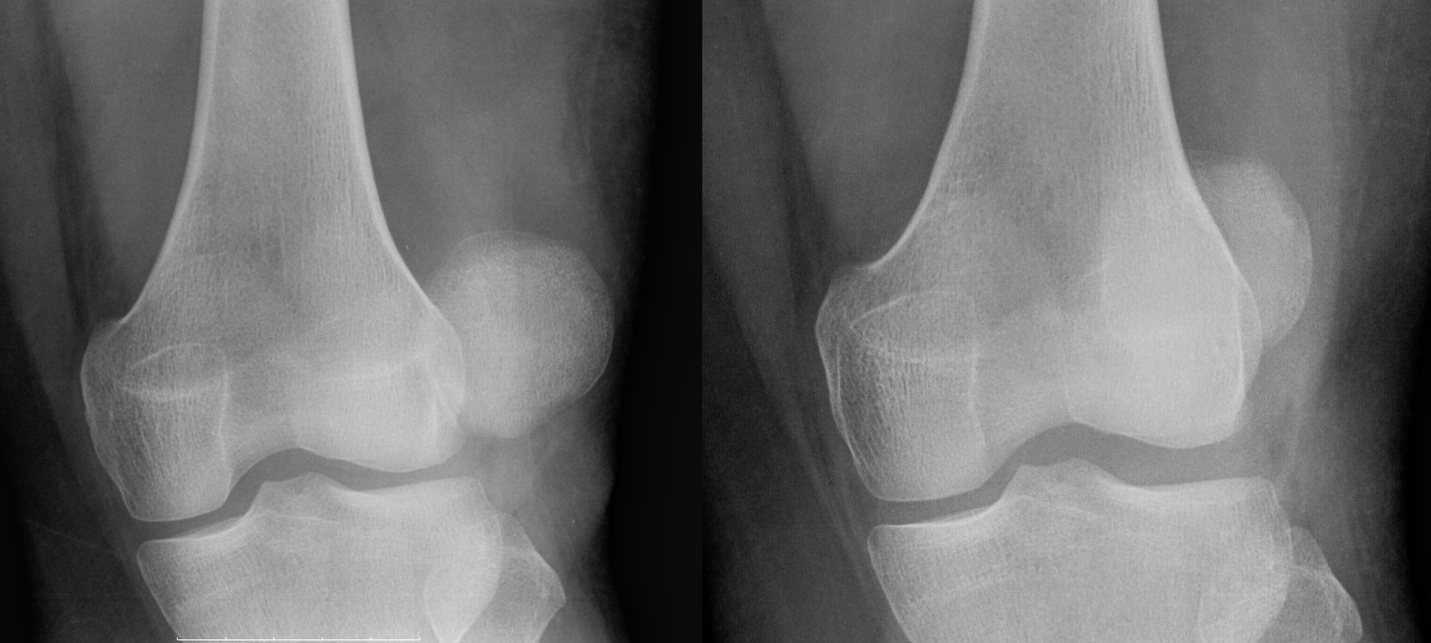luxating patella